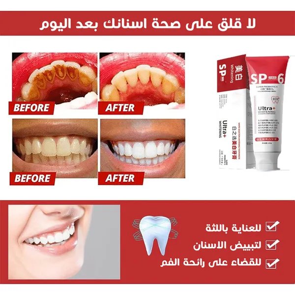 SP6 - المعجون الأسرع و الأقوى لتبييض الأسنان