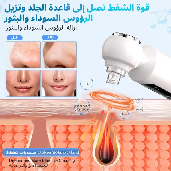 جهاز إزالة الرؤوس السوداء وشفط المسام مع 3 مستويات من الشفط