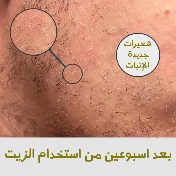  زيت تحفيز بصيلات اللحية